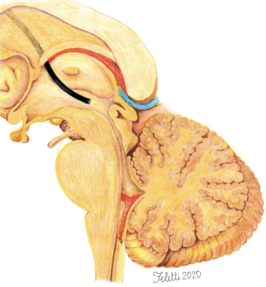 Traiettoria dell'endoscopio nel terzo ventricolo
