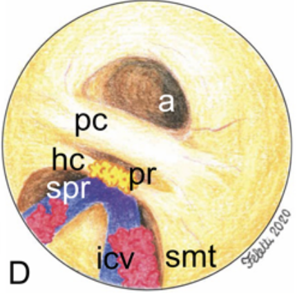 Terzo ventricolo nell'idrocefalo cronico