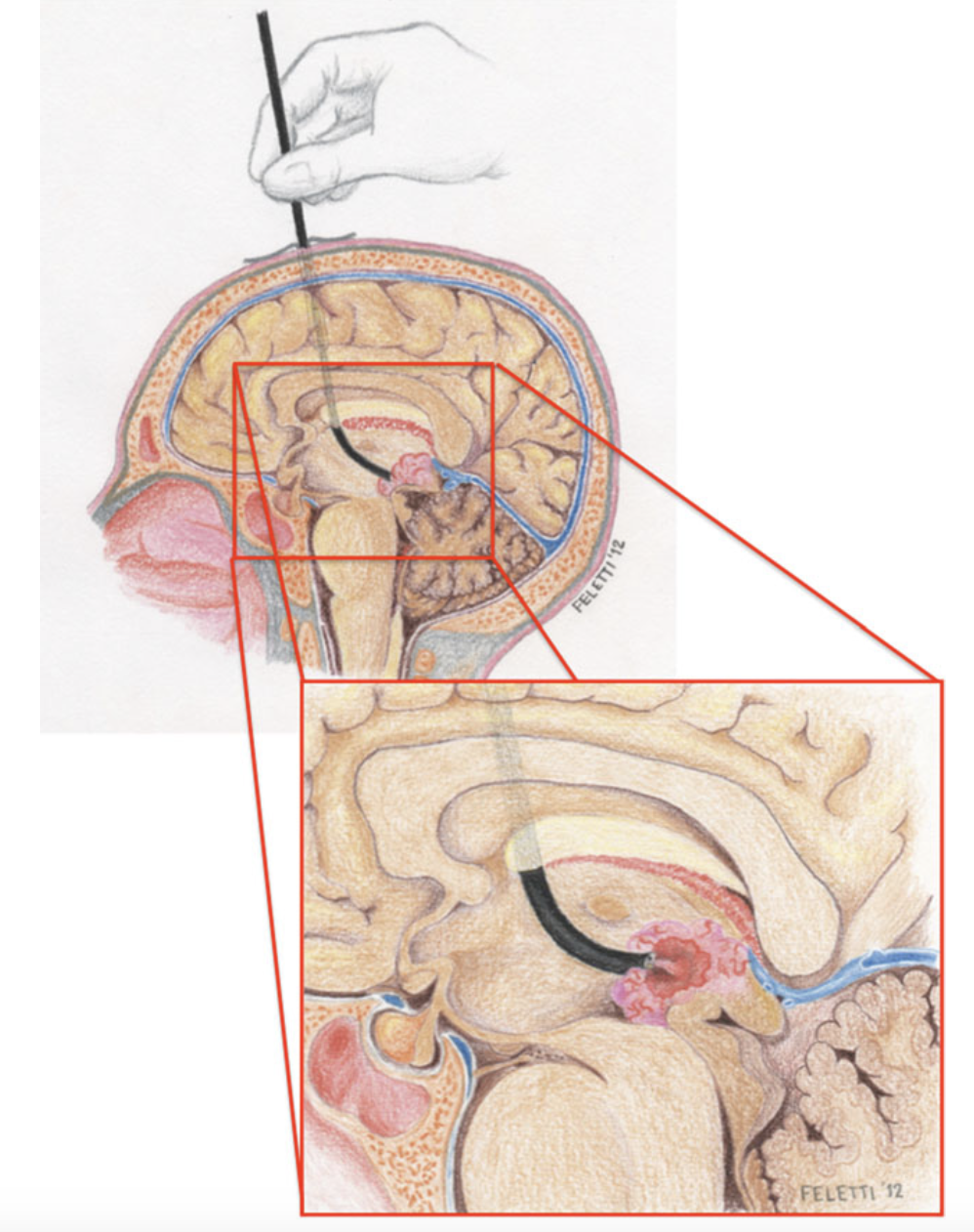 Aspirazione tumorale endoscopica