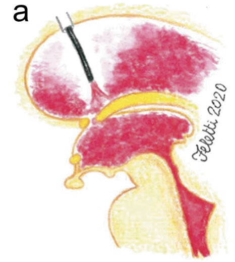 Aspirazione IVH – ventricolo laterale