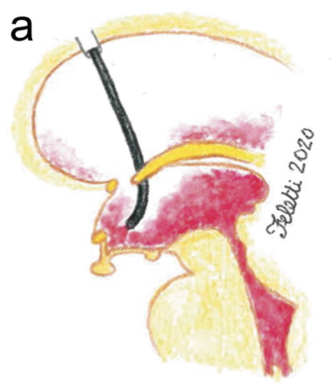 Aspirazione IVH – terzo ventricolo