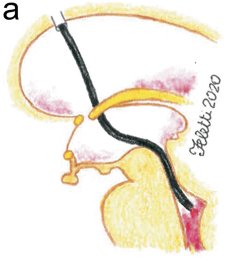 Aspirazione IVH – quarto ventricolo