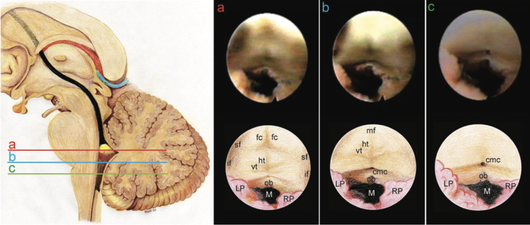Anatomia del quarto ventricolo – orientamenti endoscopici