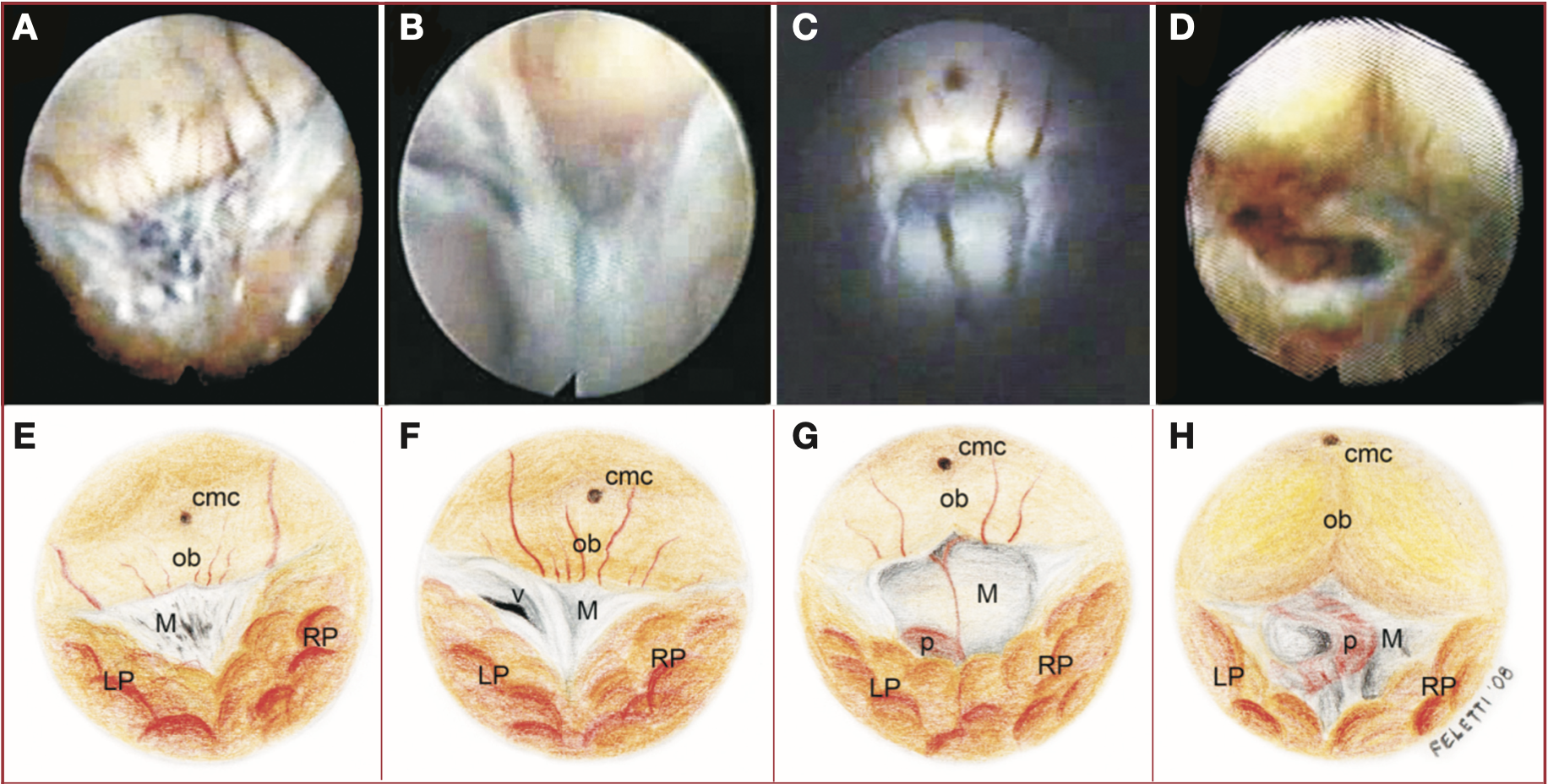 Tipi di occlusione del forame di Magendie
