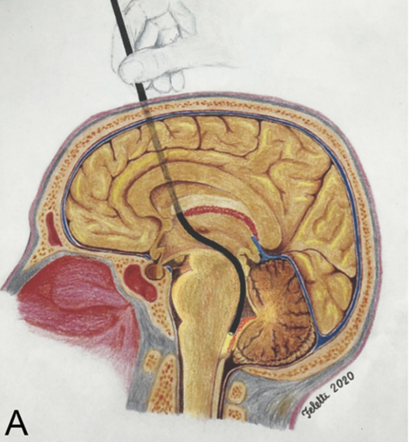 Anatomia del calamus scriptorius