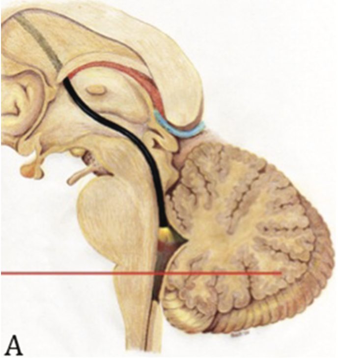 Traiettoria endoscopica verso l'area postrema