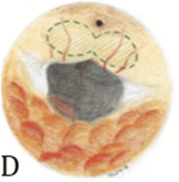 Vista endoscopica dell'area postrema – luce bianca