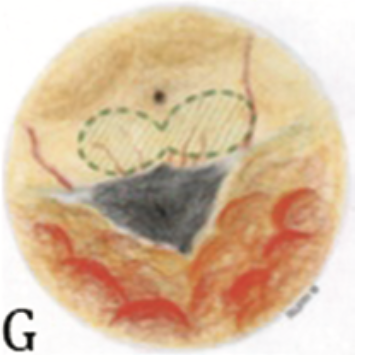 Vista endoscopica dell'area postrema – fluorescenza